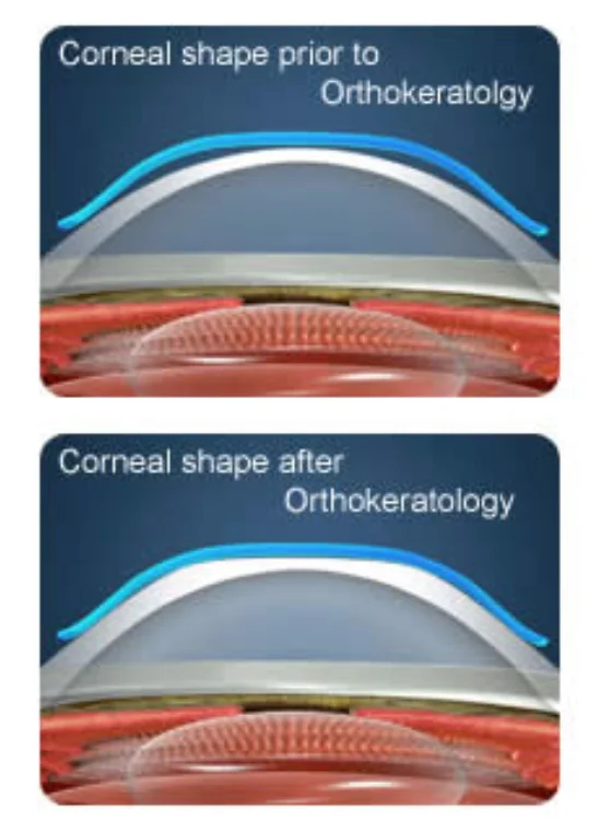 Corneal Shaping for Hign Myopia.