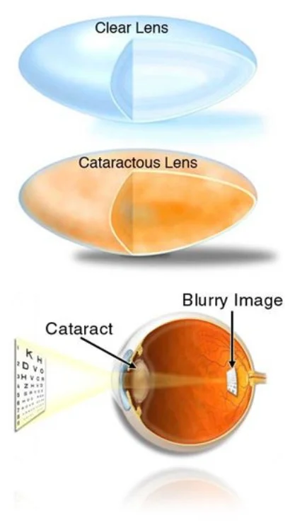 Illustration+of+Cataracts+Dr+Brendan+Cronin+Brisbane.jpg
