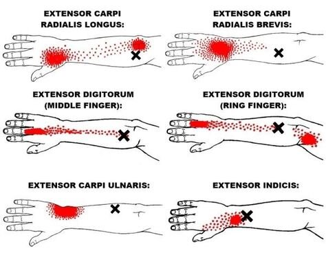 Trigger Points… - Where someone feels their pain in an area (red colouration on diagram), it can be caused by an active trigger point in a muscle some distance away (X). Each muscle has definite patterns of pain specific to their trigger points.