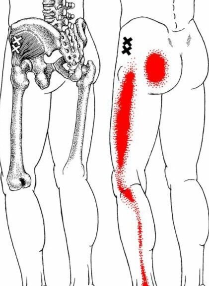 Leg Pain… - This diagram shows that the muscle TFL (Tensor Fascia Lata) has a trigger points (XX) on the outside of the hip which refer pain into the buttock and down the outside of the leg.Often Sciatica can be casued by trigger points in piriformis, and in fact is not true sciatica which would come from the back.