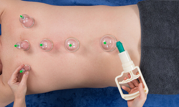 Dry Cupping… - This is an alternative technique used on muscles to help relieve tension and pain.Dry cupping is used to apply a vertical stretch of the tissues, through the suction applied. This helps promote blood flow to the surface and to aid relaxation of tight tissues. To increase the effect further, the cup can be glided on the surface of the skin.There is a high risk of  marking of the skin or bruising.