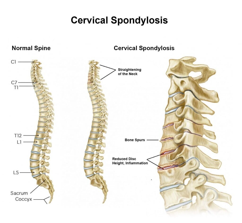 cervical traction… - Traction creates a minimal separation of adjacent vertebrae, to create space to help with pain relief or stiffness of the spine.Conditions treated:* Spondylosis* Cervical headaches* Prolapsed intevertebral disc* Nerve pain into the arm due to entrapment
