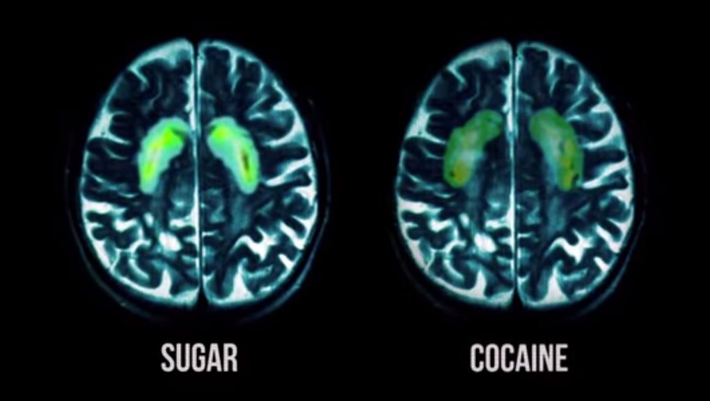 SUGAR IS ADDICTIVE JUST LIKE COCAINE! Well let's see what happens when you look at the brain under MRI compared to petting a puppy? What about an orgasm? The pleasure center of the brain may light up, but there's more to it than that. We choose high&