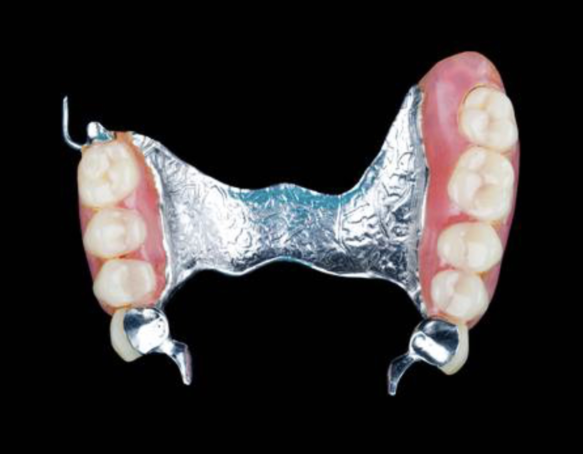 Metal Partials partial denture clasps Kissimmee Dental — Dental