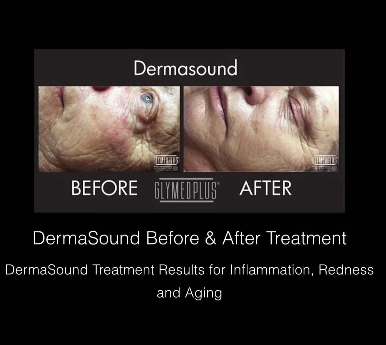 Dermasound What Is Dermasound Treatment? , eMatrix – LFAFQ