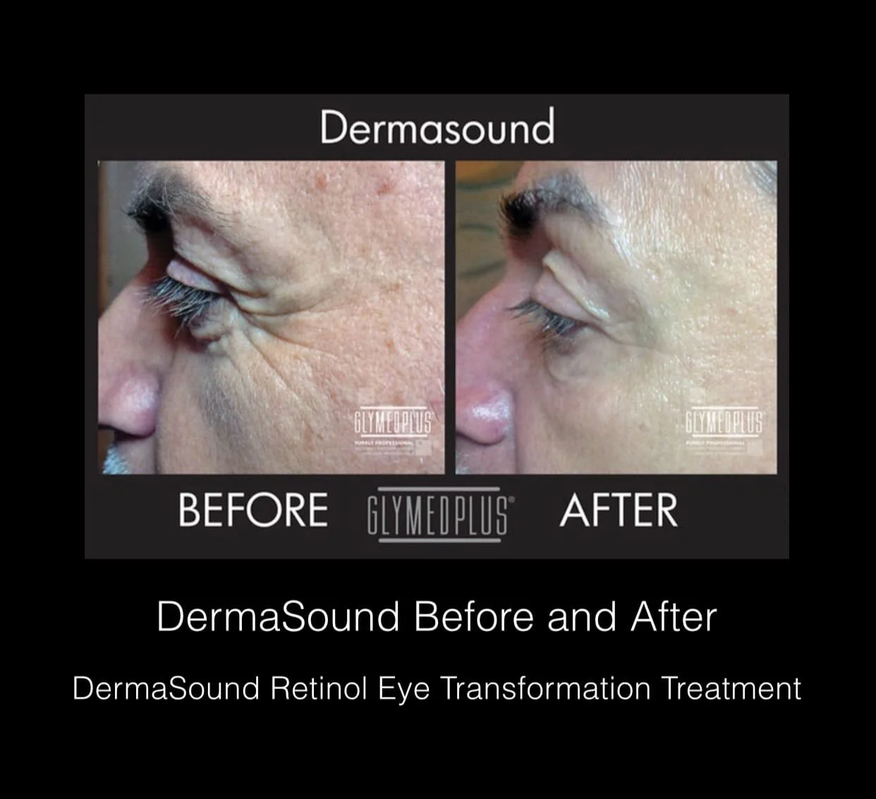 dermasound facial near me