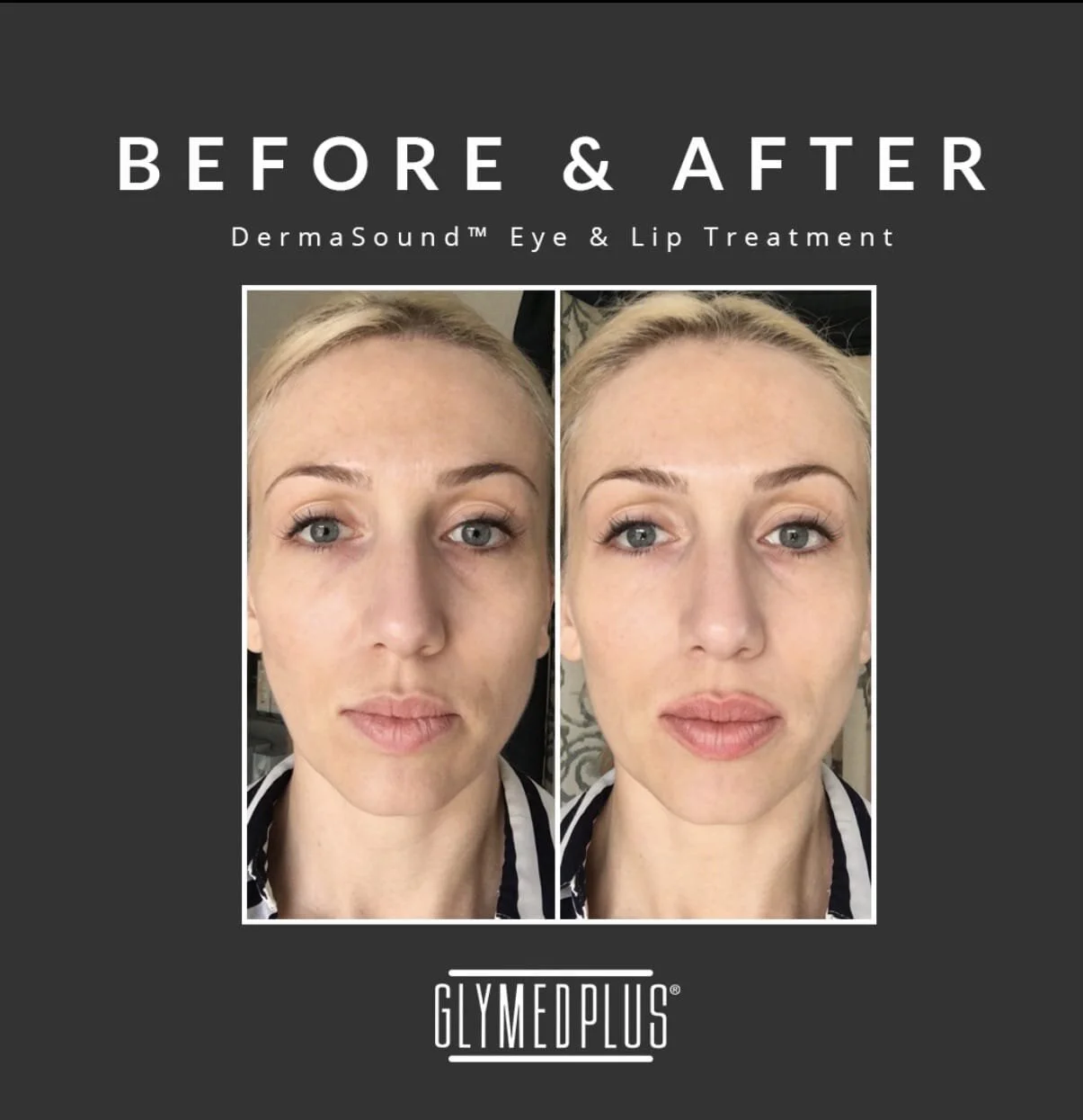 dermasound facial near me