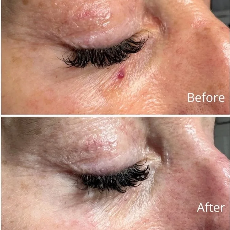 Cherry Angioma