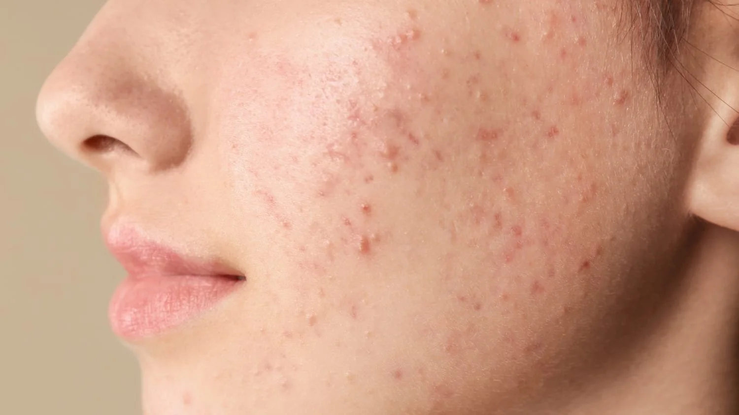 Acne Scar Treatment in Naples FL: What Actually Works
