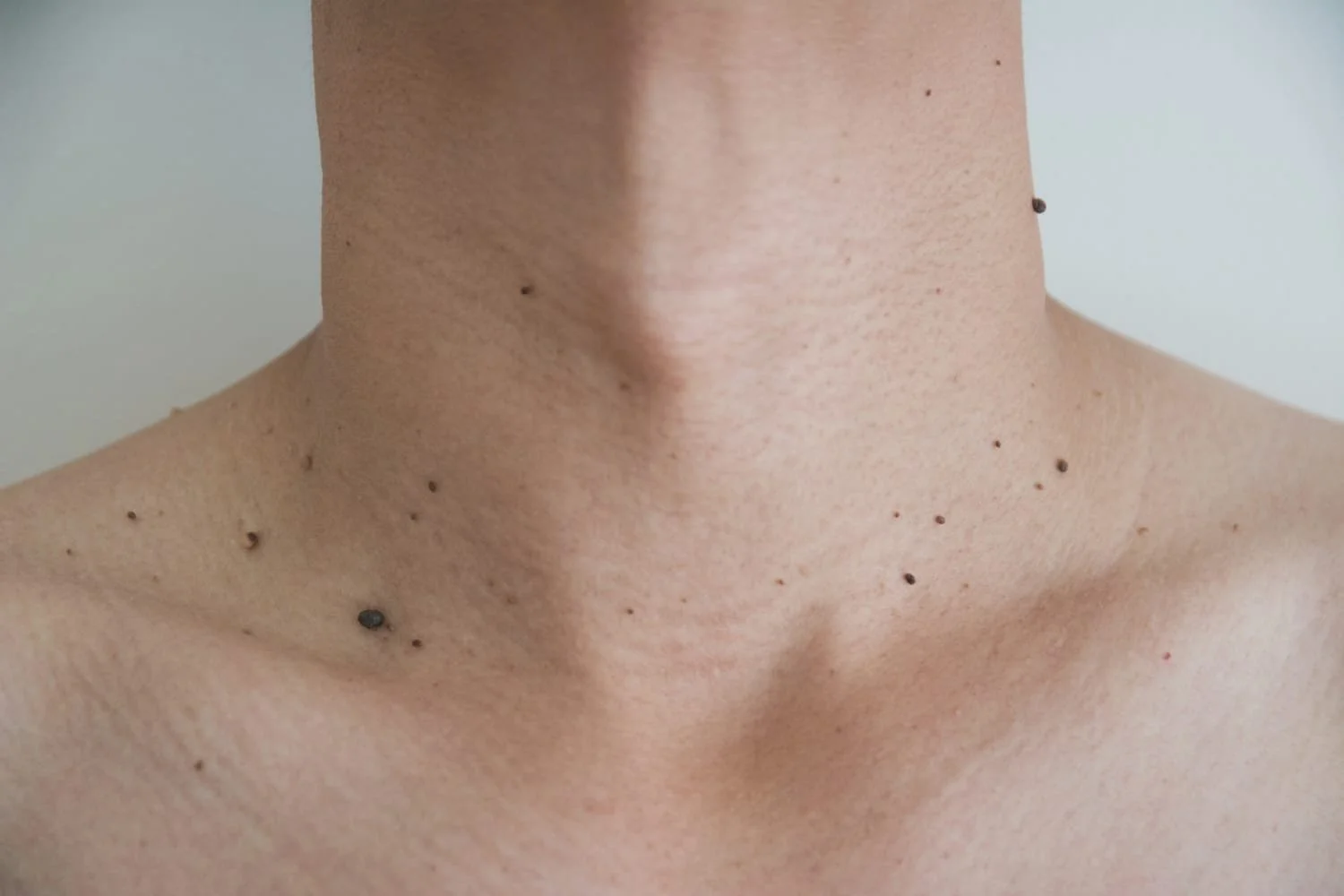 skin-tag-remova-naples-fl.jpg