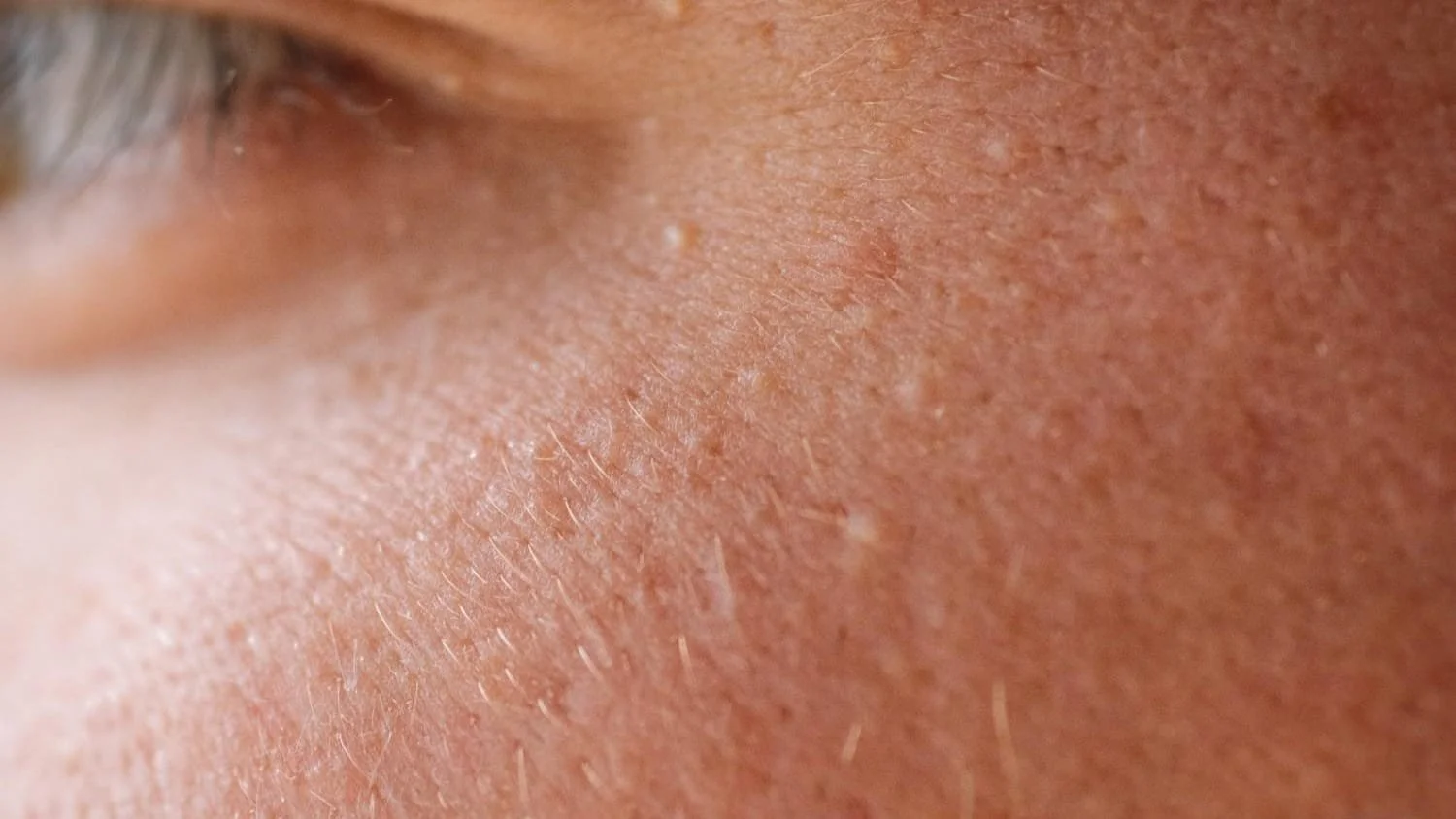 Milia bumps under eye closeup