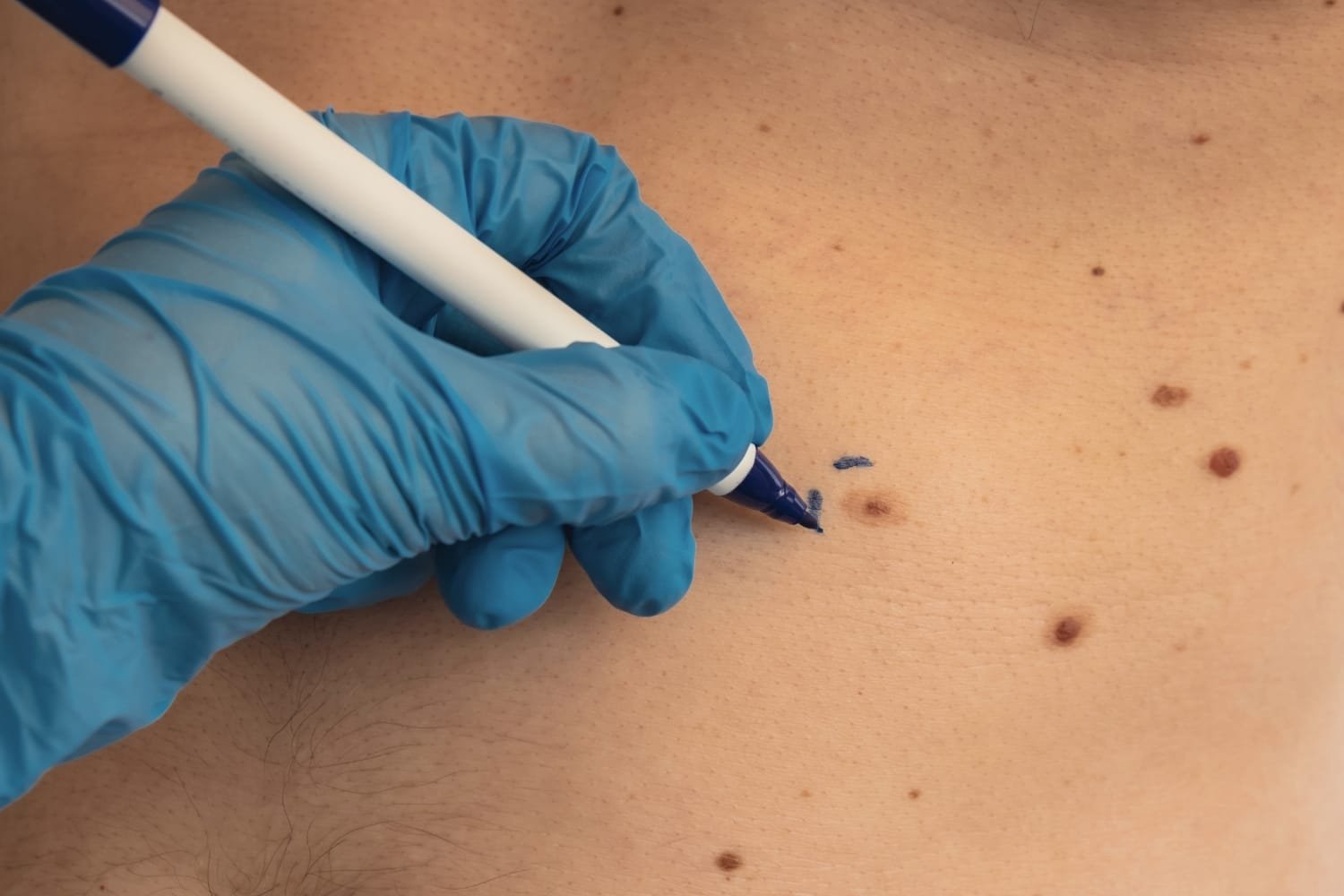 Skin tag treatment in Naples, FL by Kim Gallo