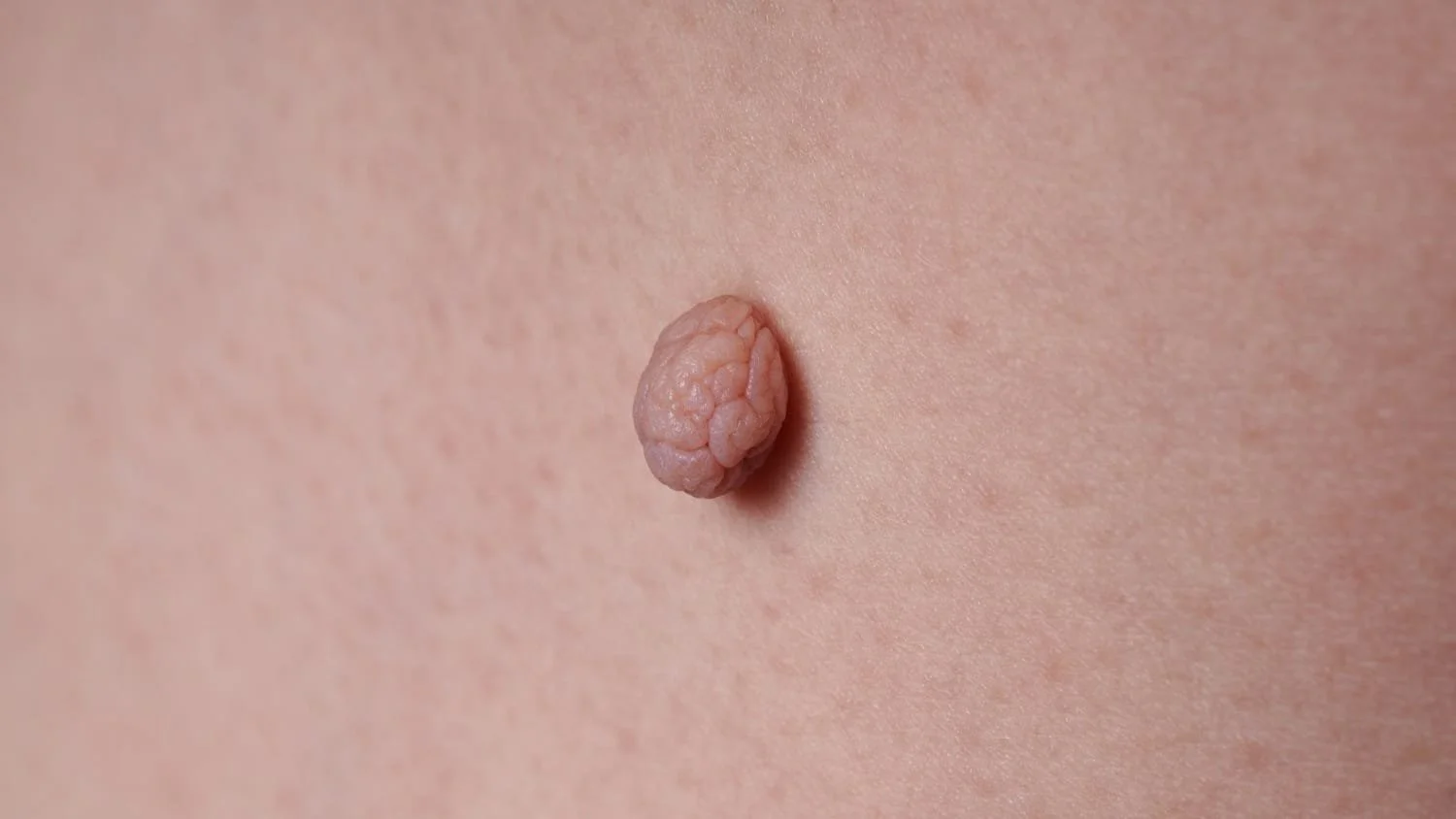Close up of a skin tag