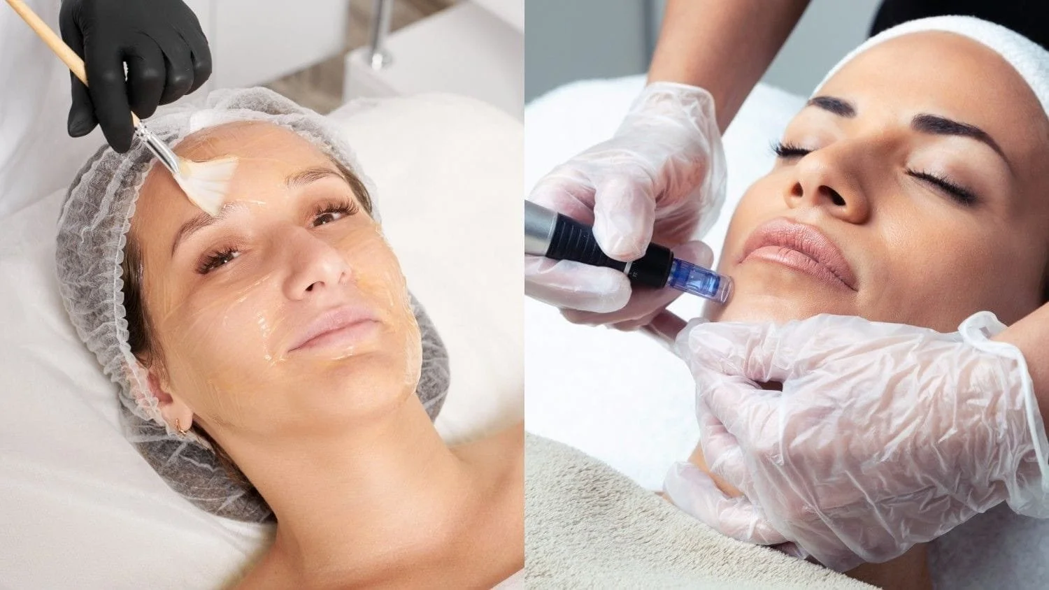 comparison of chemical peels and microneedling