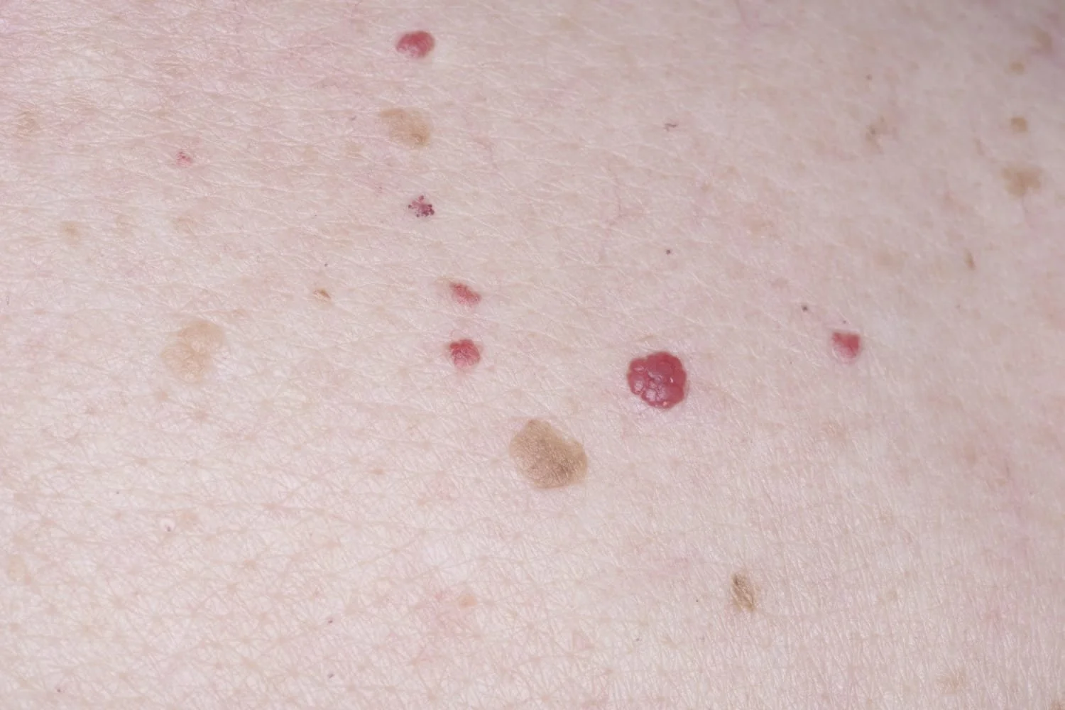 cherry-angioma-removal-naples-fl.jpg