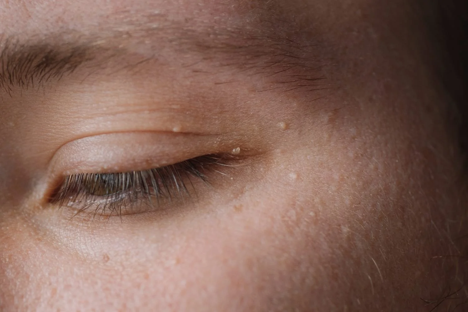 milia-treatment-naples-fl.jpg