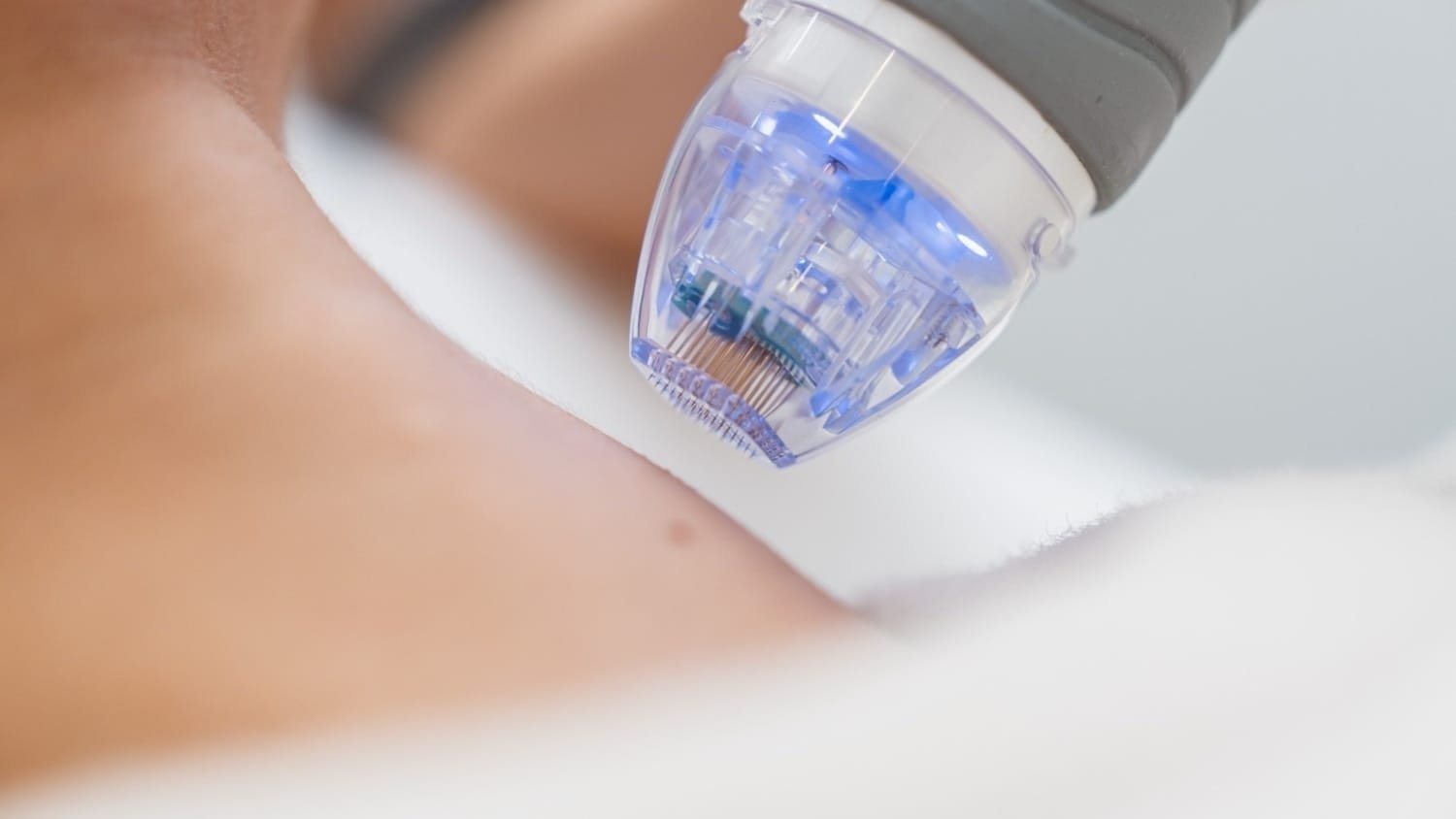 Esthetician in Naples, FL using a microneedling pen