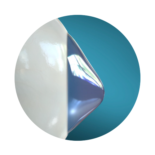 keratoconic cornea (1).png