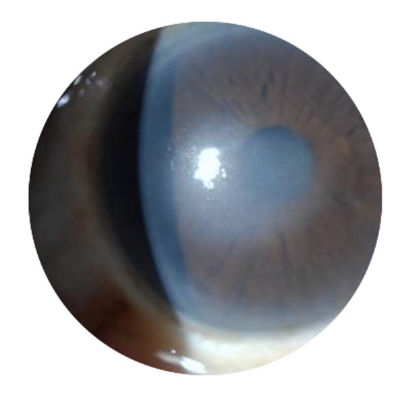 Fuchs-Dystrophy.png