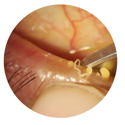 meibomian-gland-dysfunction-treatment.png