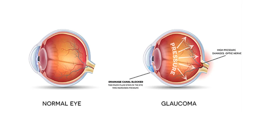 glaucoma.jpg