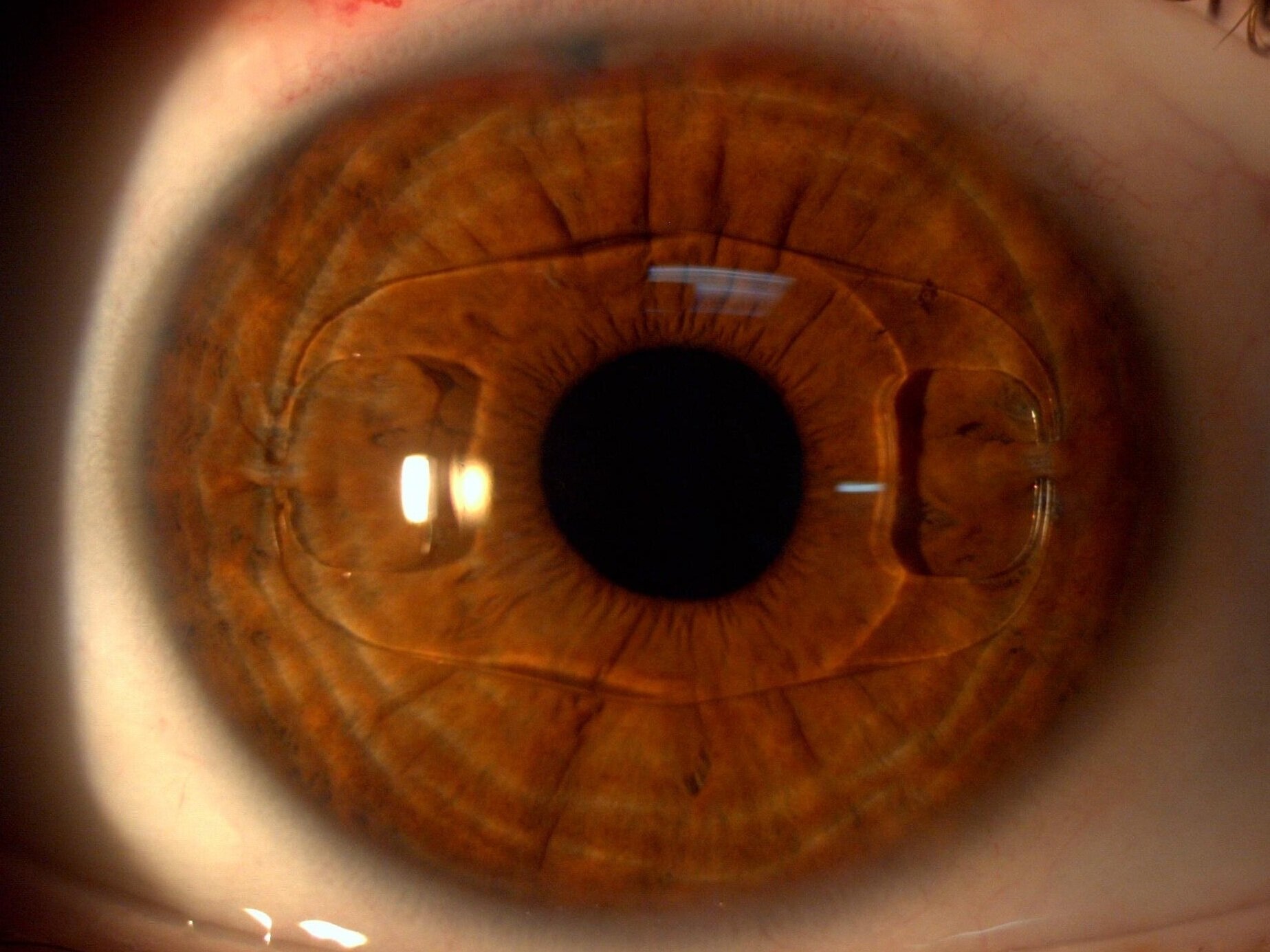 Verisyse+1+day+postop.jpg
