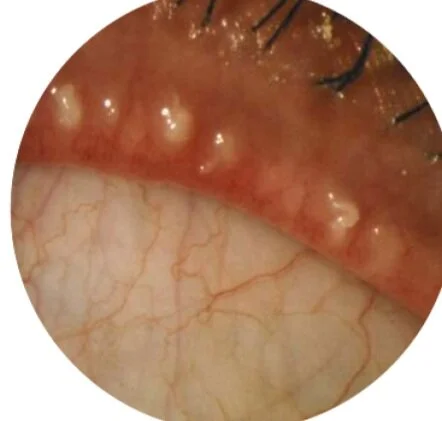Meibomian Gland Dysfunction Moyes Eye Center Meibomian Gland Dysfunction Moyes Eye Center