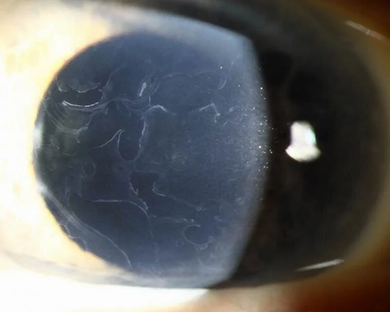 Map Dot Fingerprint Dystrophy