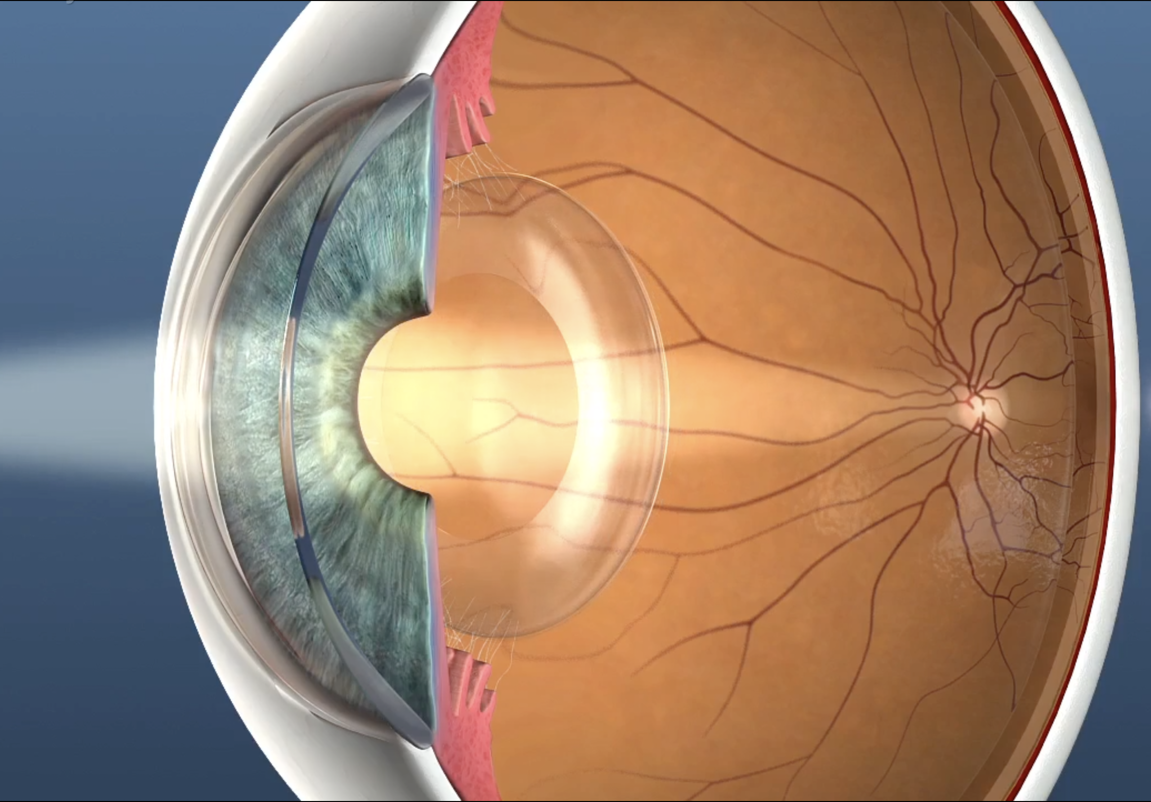 Cataract removed, capsular bag in place