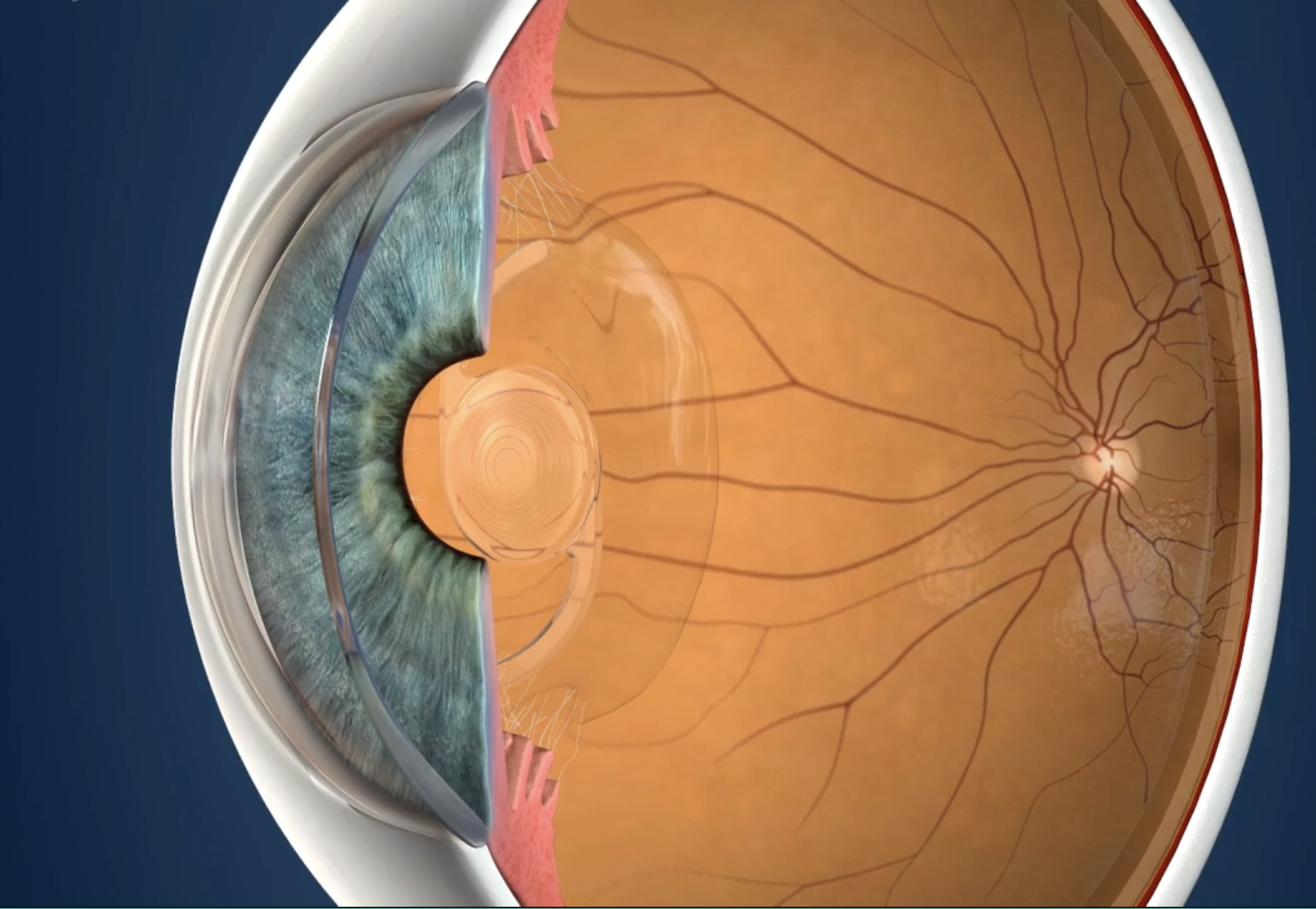 Lens implant placed within capsular bag