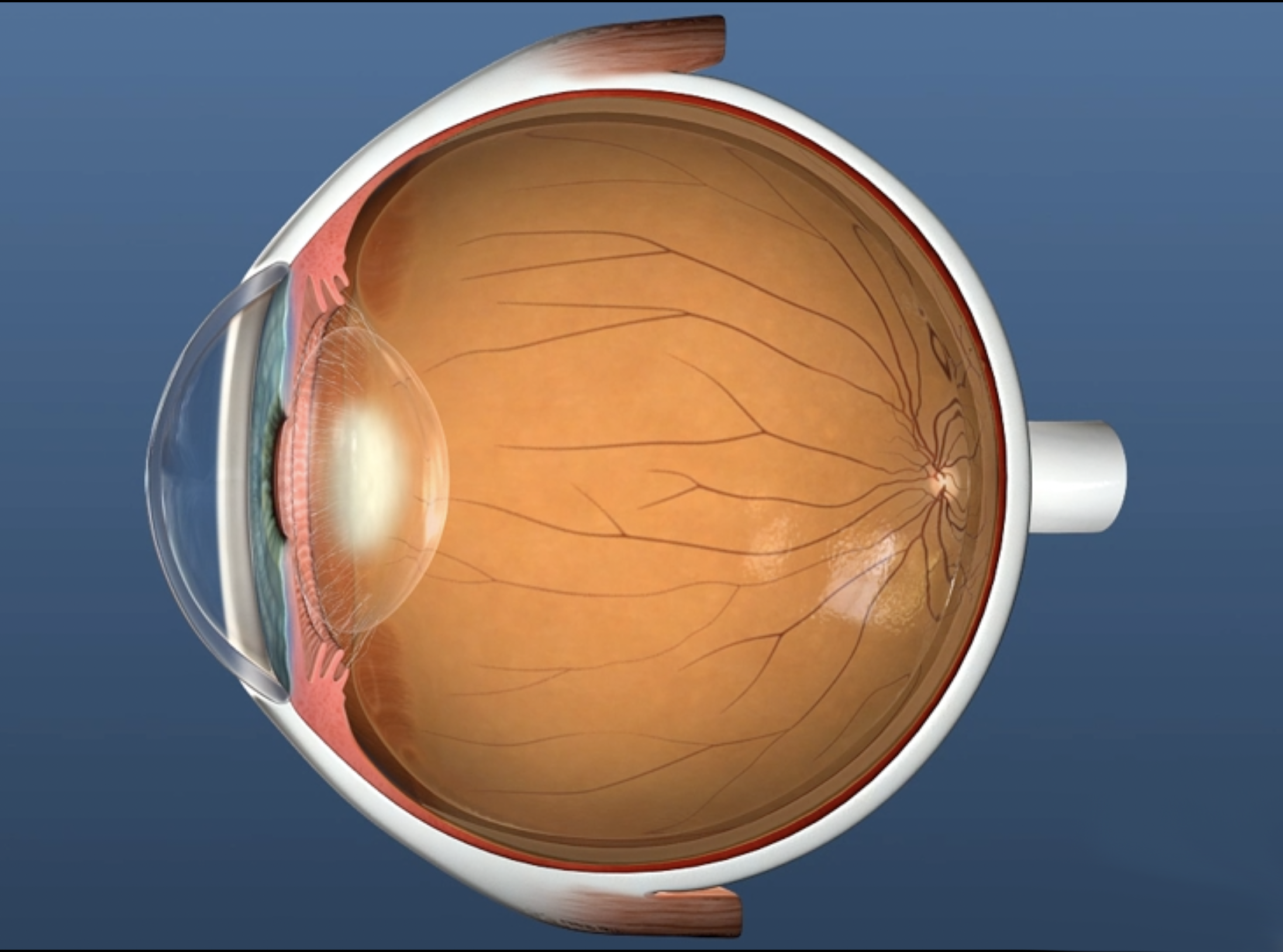 Cataract forming in lens