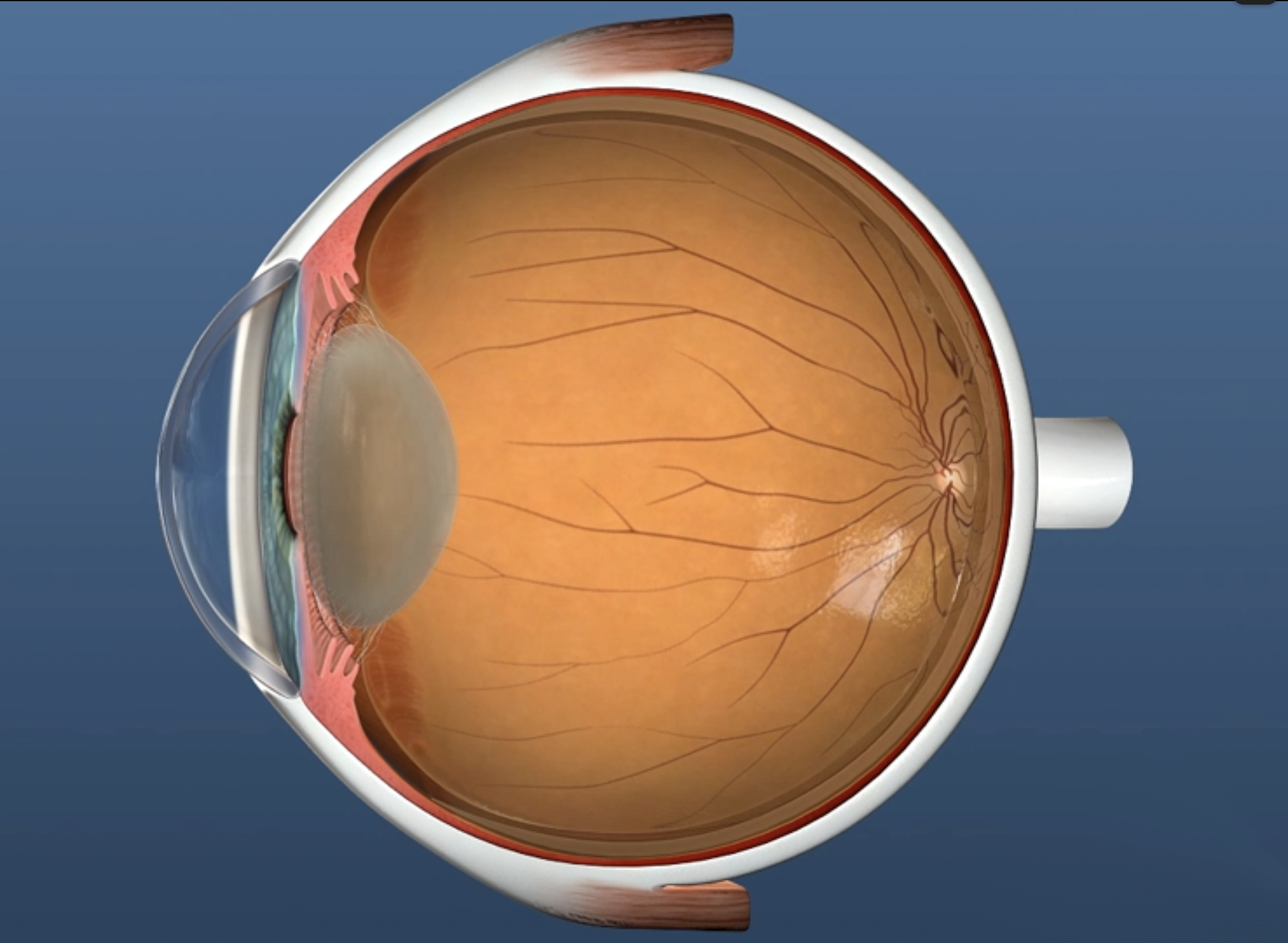 Cataract fully formed in lens