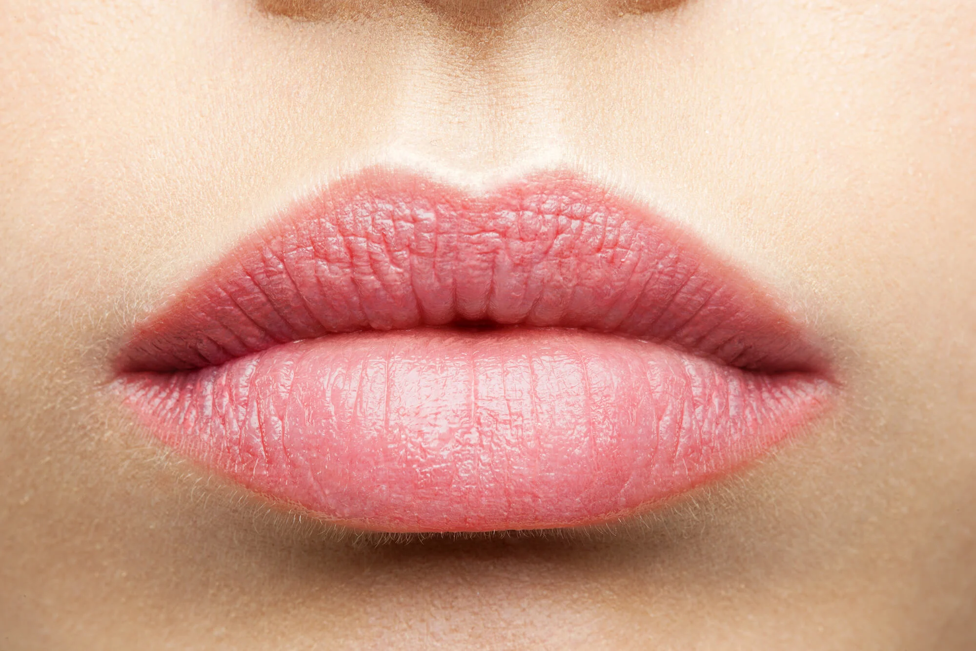 Fuller lips with dermal fillers