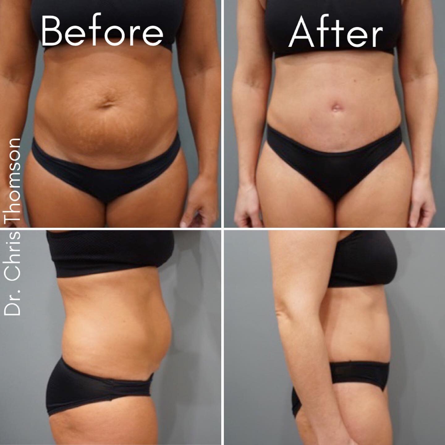 Before and After 🌸 tummy tuck. ⁣
⁣⁣
⁣⁣
⁣⁣
⁣⁣
⁣⁣
⁣#tummytuck #plasticsurgery #drchristhomson #beforeandafter #reveal #glowup