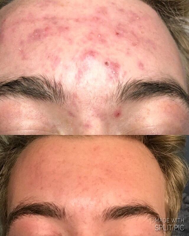 You can achieve clear healthy skin with commitment , guidance and proper skin care. NO accutane needed! 👍🏼
#acne #clearingskin #acnechallenges #cysticacne #inflamedacne #acnerehab #esthetician #acnespecialist #glowingskin #virtualacnecare #longterm
