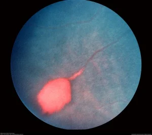 Episode 11: Sickle Cell Retinopathy (and other manifestations)
