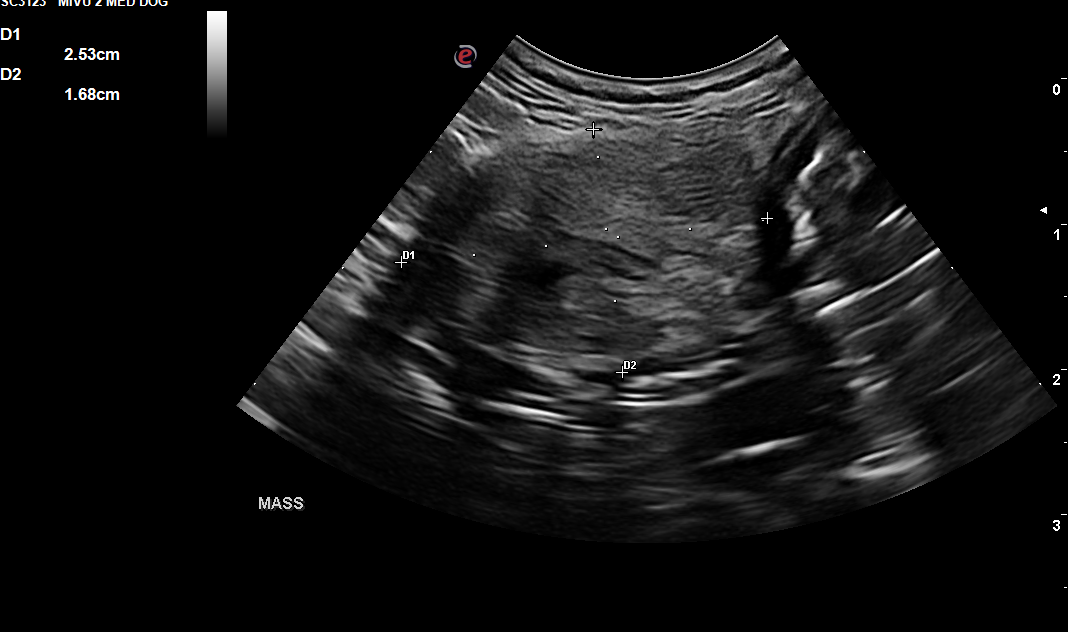 Incidental Abdominal Mass