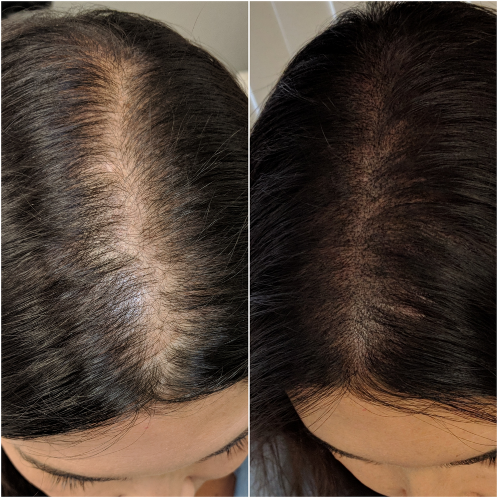 Scalp Micropigmentation — The Perfect Eyebrows - Orange County Microblading  & Microshading Studio