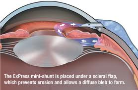 images - glaucoma.jpeg