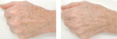 before-after-hand-revision.jpg