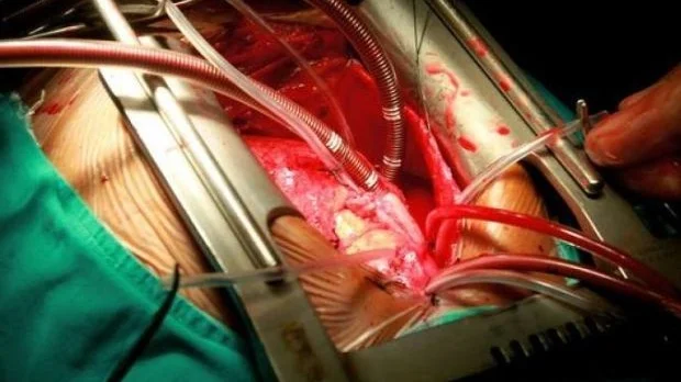 open_heart_surgery_AFP+%281%29.jpg