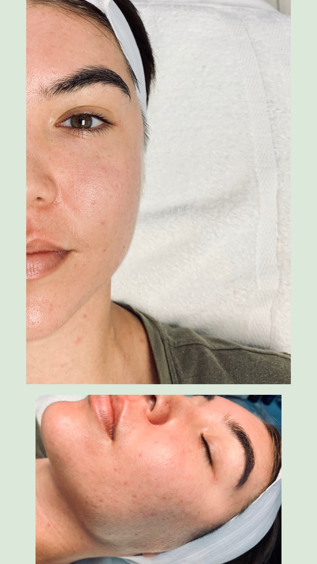 face needling