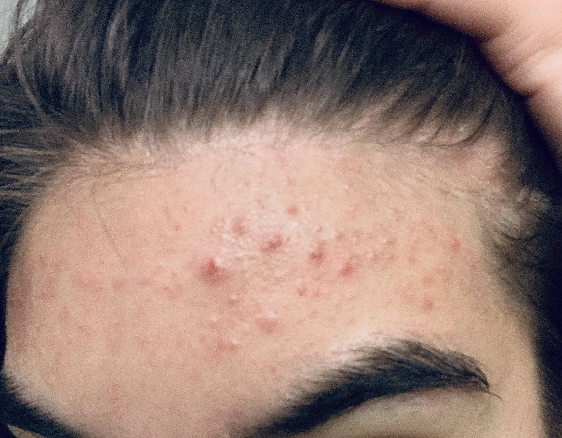 iud and accutane