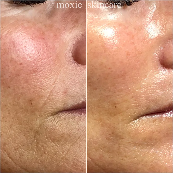 DMK Muscle Banding Enzyme Therapy is the perfect non-invasive alternative to injectables. Notice the nasolabial fold has filled out and the skin is brighter, smoother and glowing immediately following treatment.