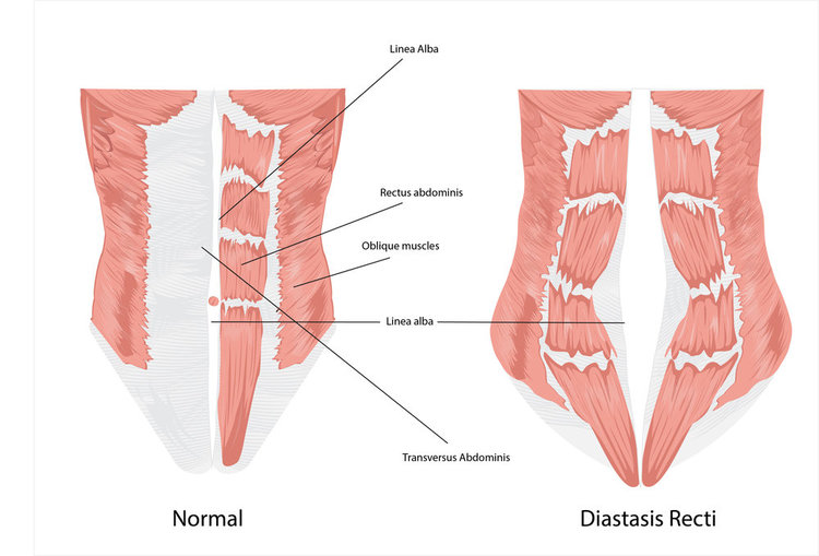 Debunking Myths about Diastasis Recti and When Pelvic Floor Physical  Therapy Can Help — Solstice Physiotherapy