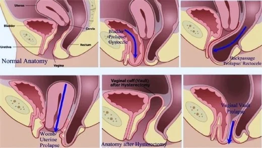 Photo: Sports Plus http://www.sportsplus.ie/womens-health/pelvic-organ-prolapse