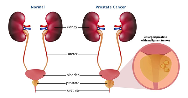 Prostate Cancer images — Dr Matthew Winter