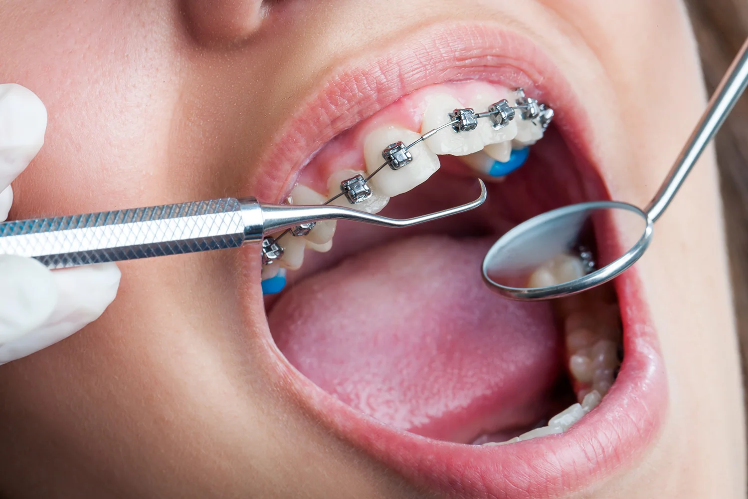 BirchRunBraces.jpg