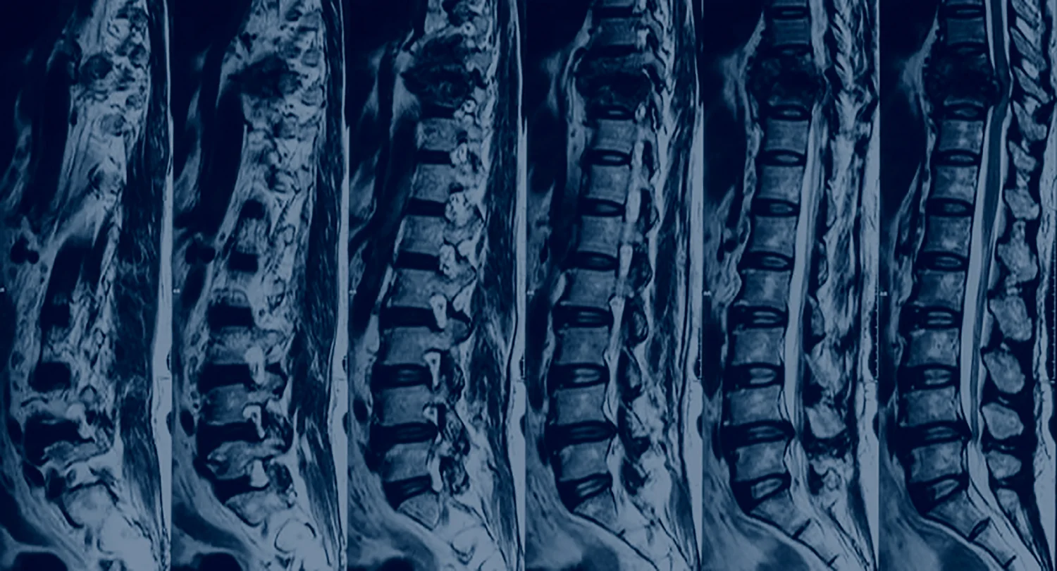 The Importance of Identifying and Treating Vertebral Compression Fractures