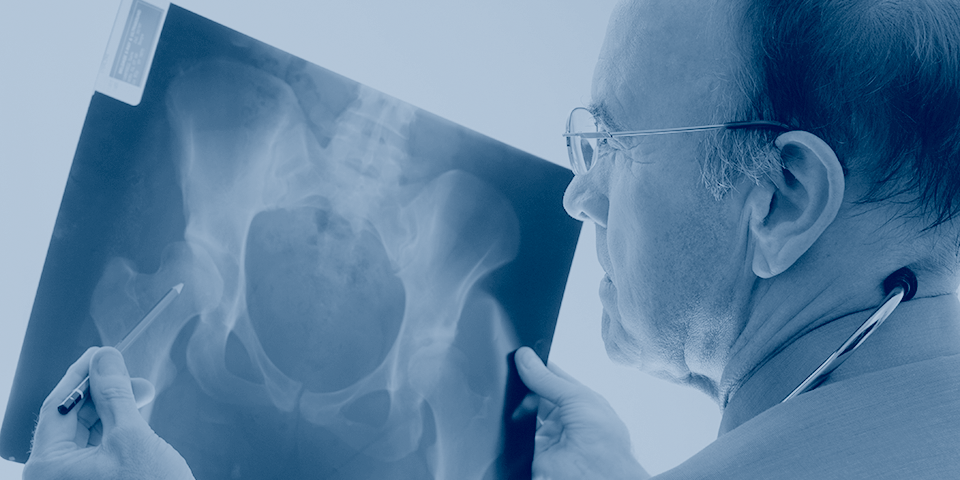 Osteoporosis and Parkinson’s